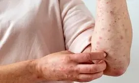 هشدار یک متخصص درباره شیوع بیماری عفونی در فصل بهار