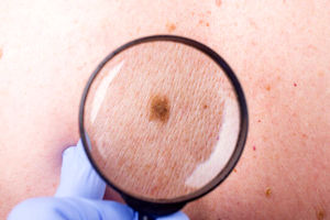 کدام سرطان پوستی خطرناک تر است؟