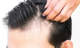 هورمونی که ریزش مو را درمان می‌کند

