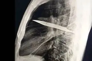 کشف عجیب در قفسه سینه؛ چاقویی که ۸ سال در بدن مردی جا خوش کرده بود