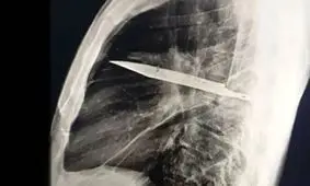 کشف عجیب در قفسه سینه؛ چاقویی که ۸ سال در بدن مردی جا خوش کرده بود