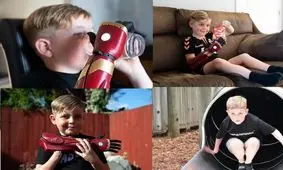 کودکی بدون دست که صاحب دست آهنی شد/ ویدئو