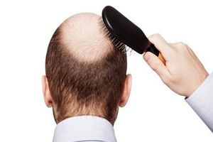 ریزمغذی‌های مفید برای جلوگیری از ریزش مو