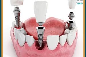 قیمت کاشت ایمپلنت دندان در سال ۱۴۰۱