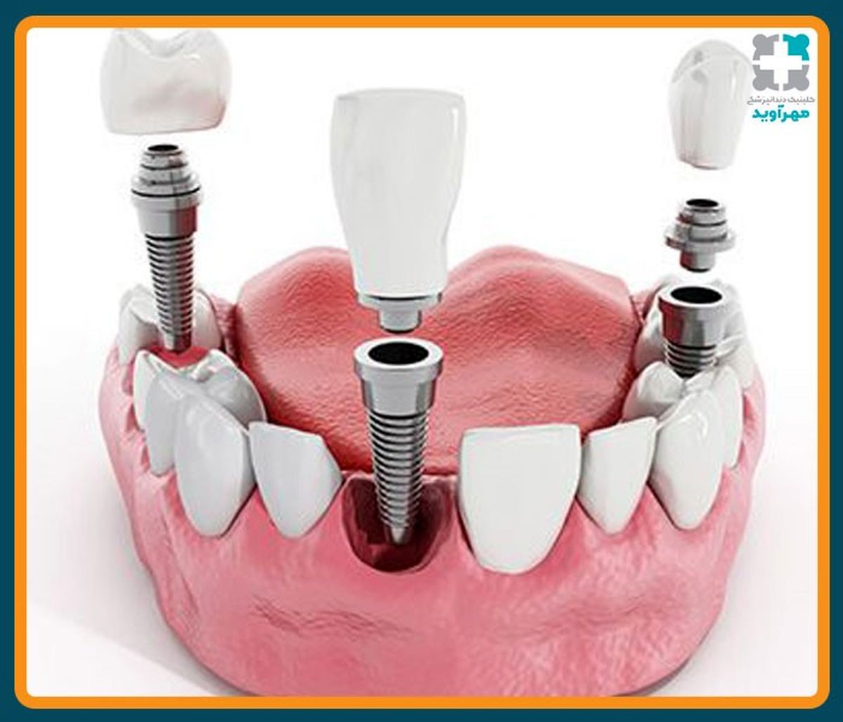 قیمت کاشت ایمپلنت دندان در سال ۱۴۰۱