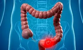 ارتباط عجیب میان سرطان روده و افسردگی