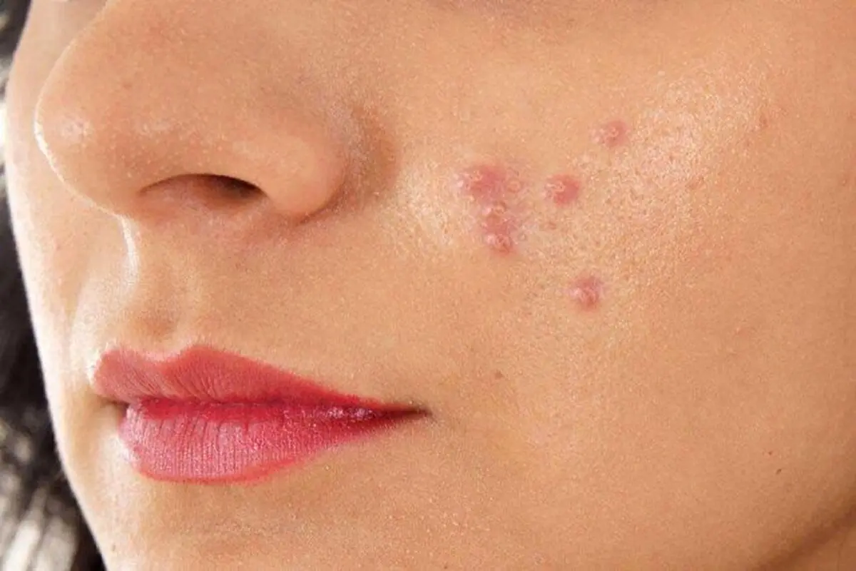 از ارتباط بین آکنه های پوستی با قند و شکر چه می‌دانید؟