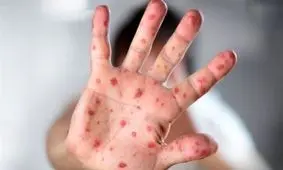 هشدار جدی؛ شیوع گسترده سرخک در کشورهای همسایه ایران