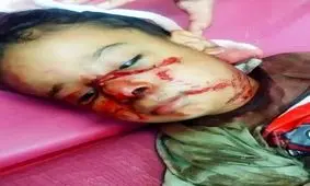 حمله سگ‌های ولگرد به کودک ۴ ساله در خوزستان