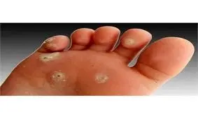 چرا پا «میخچه» می زند؟