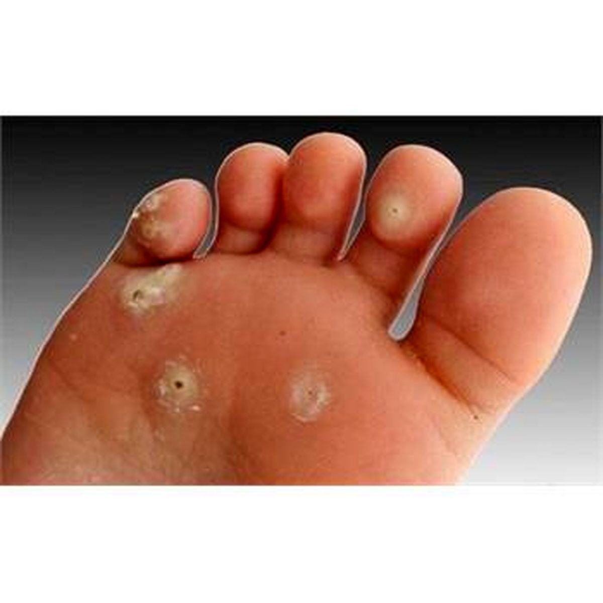 چرا پا «میخچه» می زند؟