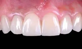  کمترین قیمت ایمپلنت فوری  با کلینیک دکتر دهقان