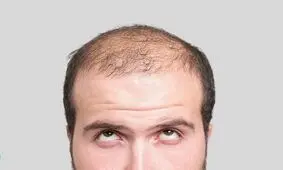 جوان ایتالیایی طاسی سرش را با تتو پوشاند/ عکس 