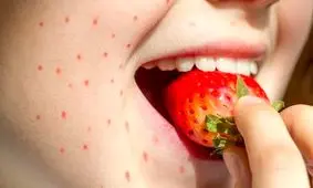 علایم حساسیت به توت فرنگی