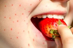 علایم حساسیت به توت فرنگی
