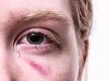 در زمان تروما یا ضربه به چشم در اثر انفجار چه باید کرد؟/ هشدار: به آسیب‌دیدگان چشمی، آب یا غذا ندهید/ خوددرمانی با قطره و مالش چشم، ممنوع