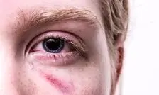 در زمان تروما یا ضربه به چشم در اثر انفجار چه باید کرد؟/ هشدار: به آسیب‌دیدگان چشمی، آب یا غذا ندهید/ خوددرمانی با قطره و مالش چشم، ممنوع