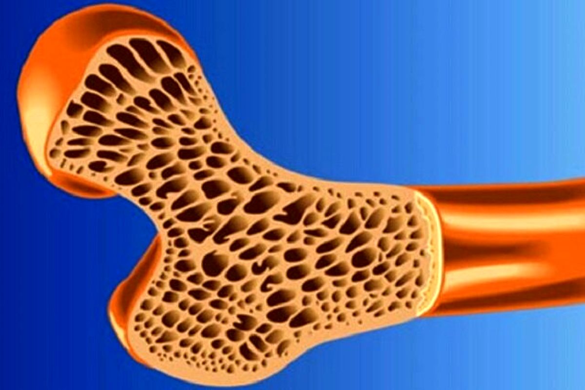 پوکی استخوان در نیمی از جمعیت کشور/ پوکی استخوان در زنان بیشتر از مردان