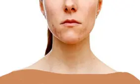 علل بیماری کندن پوست چیست و چگونه درمان می شود؟