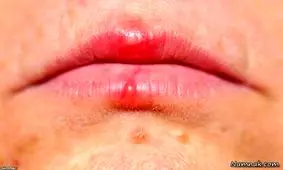 اشتباه مهلک در تشخیص آفت و تبخال؛ کدام یک مسری و خطرناک است؟