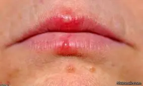 اشتباه مهلک در تشخیص آفت و تبخال؛ کدام یک مسری و خطرناک است؟