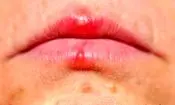 اشتباه مهلک در تشخیص آفت و تبخال؛ کدام یک مسری و خطرناک است؟