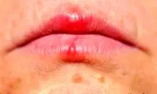 اشتباه مهلک در تشخیص آفت و تبخال؛ کدام یک مسری و خطرناک است؟