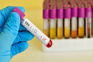 آنچه در مورد آزمایش ویروس اپشتین بار باید بدانید
