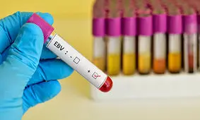 آنچه در مورد آزمایش ویروس اپشتین بار باید بدانید