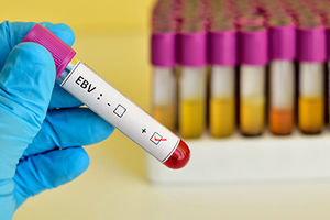 آنچه در مورد آزمایش ویروس اپشتین بار باید بدانید