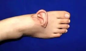 گوش برای اولین بار به پا پیوند زده شد

