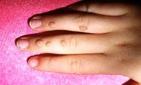 «زگیل» را چطور درمان کنیم؟