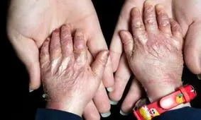 بیماری پروانه ای نتیجه جهش ژن در ازدواج های فامیلی است