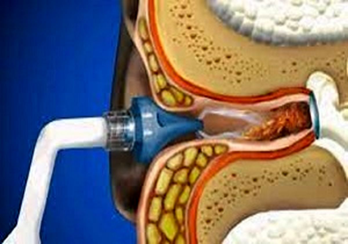 چگونه گوش هایمان را به مدت طولانی تمیز نگه داریم؟