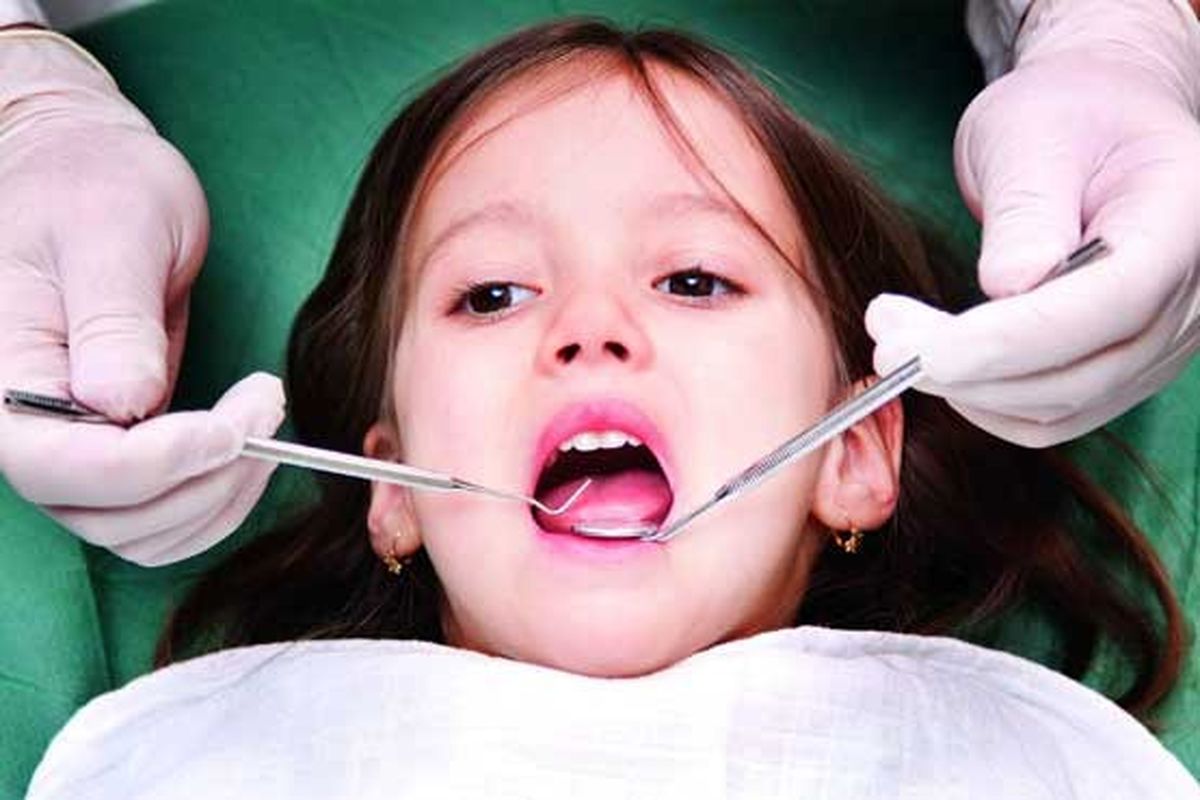 هر کودک ۶ ساله ایرانی بیش از ۵ دندان پوسیده دارد