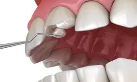 کامپوزیت دندان + مزایا معایب و قیمت