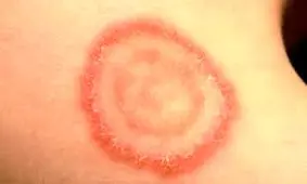 درماتوفیتوز: علل، علایم، تشخیص و راههای درمان