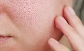 اگر پوست چرب دارید این توصیه‌ها را جدی بگیرید