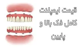 قیمت ایمپلنت کامل فک بالا و پایین