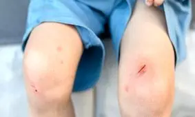 وقتی کبودی ساده می‌تواند فاجعه بار باشد