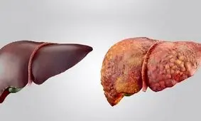 ارتباط عارضه کبد چرب با نارسایی قلبی