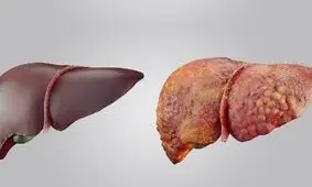ارتباط عارضه کبد چرب با نارسایی قلبی