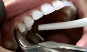 بهترین زمان برای کاشت ایمپلنت بعد از کشیدن دندان | توصیه متخصص