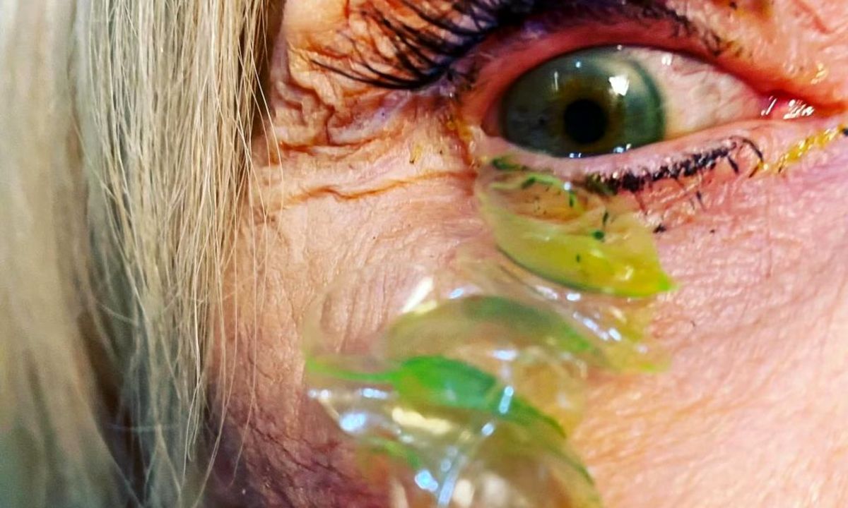 خارج کردن ۲۳ لنز چشم جامانده از چشمان یک زن ۷۰ ساله پس از دو سال
