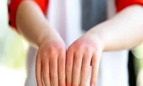 آب آوردن مفصل، نشانه ای مهم از روماتیسم مفصلی در کودکان