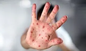 شناسایی۵۰ مورد ابتلا به سرخک در سیستان و بلوچستان 