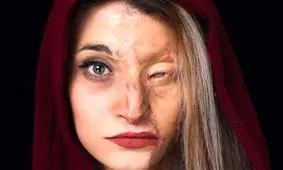 قربانیان اسیدپاشی؛ اگر قربانی این حادثه شدیم چه کنیم؟ 