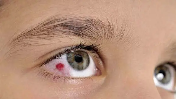 در زمان تروما یا ضربه به چشم در اثر انفجار چه باید کرد؟/ هشدار: به آسیب‌دیدگان چشمی، آب یا غذا ندهید/ خوددرمانی با قطره و مالش چشم، ممنوع!