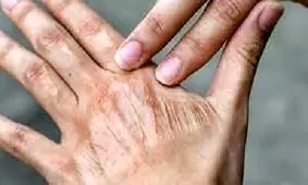 اقدام ساده برای رفع خشکی پوست