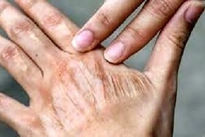 اقدام ساده برای رفع خشکی پوست